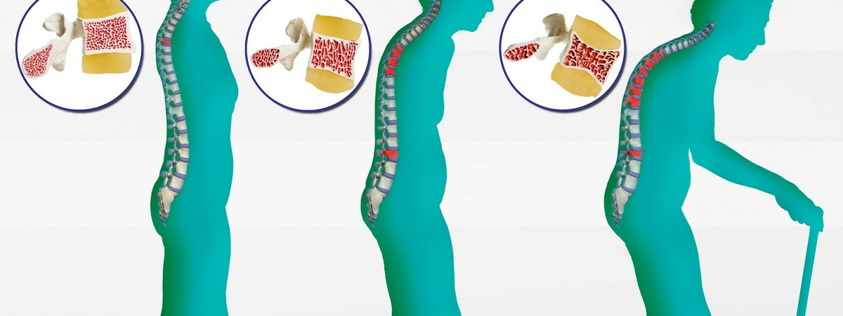 Слабые кости – бич XXI века: Врачи рассказали, как снизить риск развития остеопороза
