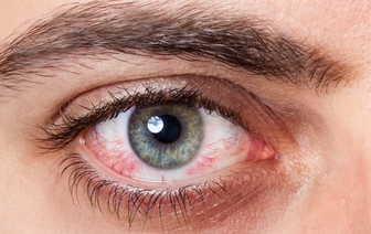 Медики рассказали, почему возникает покраснение глаз и как его лечить