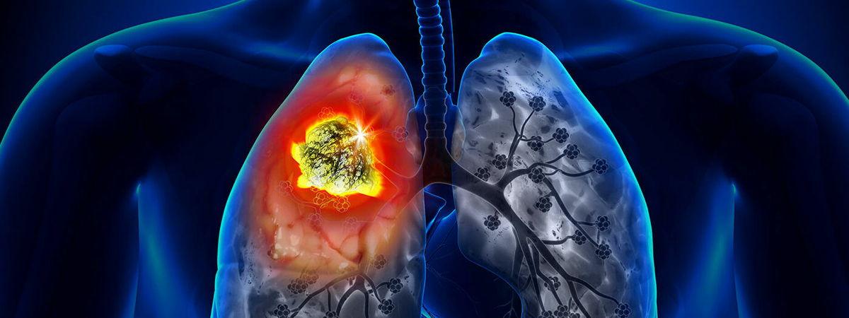 Рак легких: ученые нашли новый способ лечения