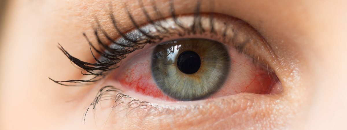 Как избавиться от красных глаз