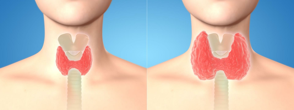 Зоб щитовидной железы: особенность организма или болезнь?