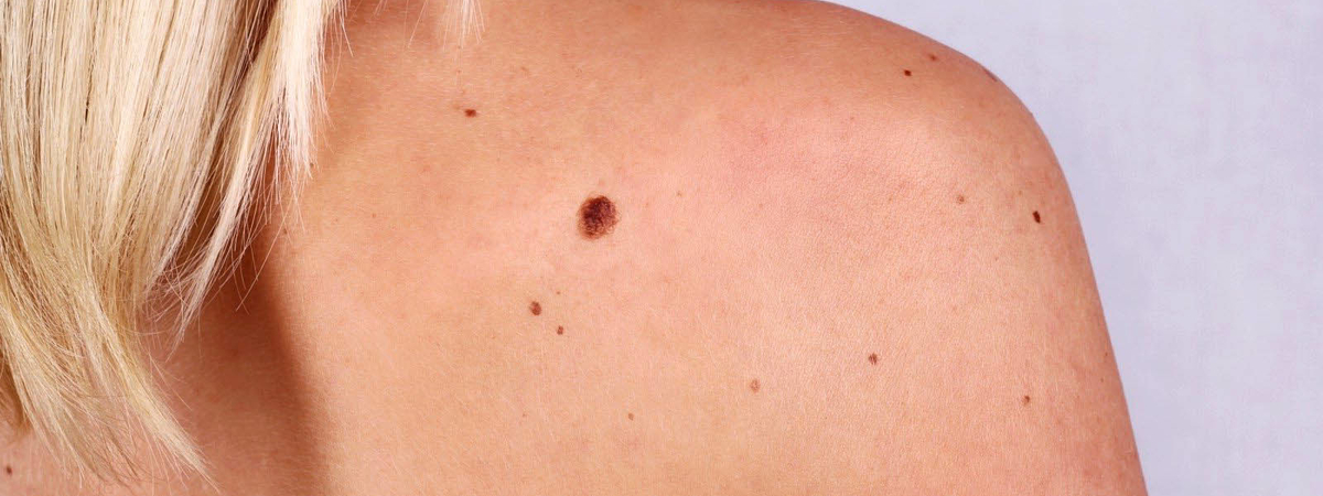 Как рак проявляется на коже, рассказали врачи