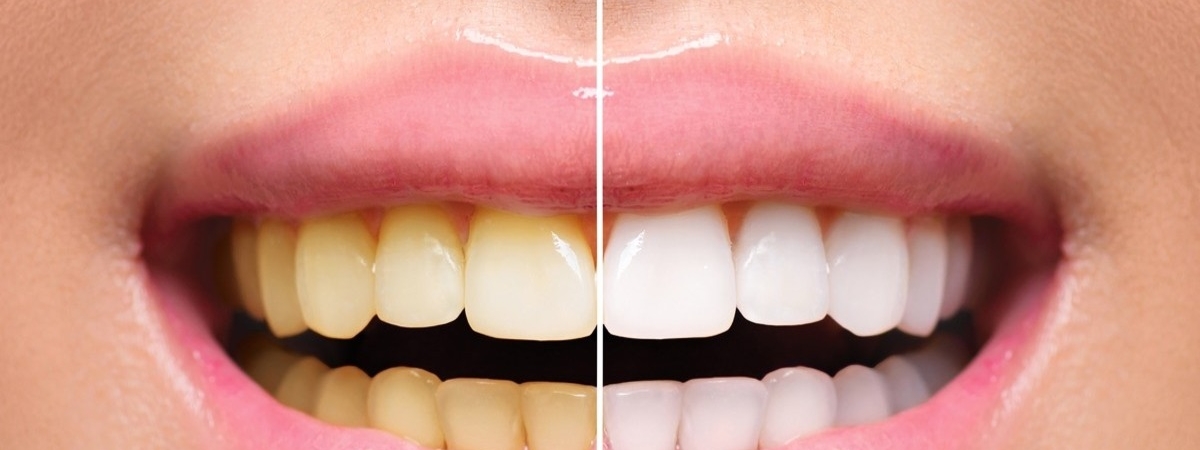 Стоматологи рассказали из-за чего желтеют зубы и как этого можно избежать