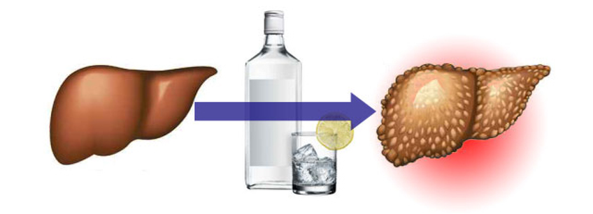 Как защитить печень от алкоголя и переедания