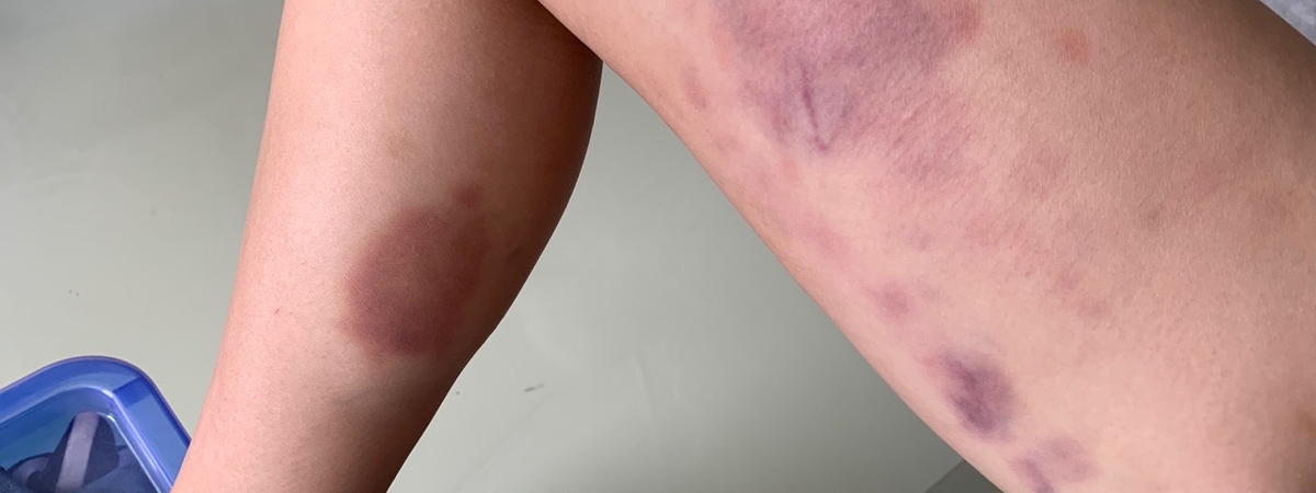 Синяки на ногах свидетельствуют о серьезных проблемах со здоровьем – врачи