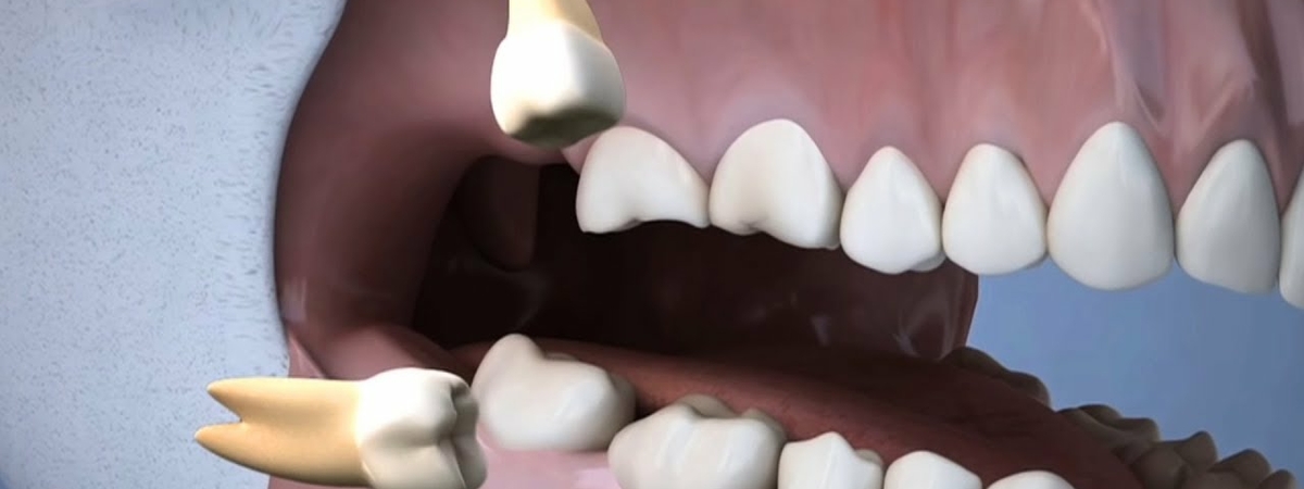 Не зуб, а загадка. Стоматологи рассказали, для чего нужны «зубы мудрости»